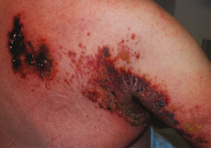 Illustration for article titled Obat Penyakit Herpes Zoster